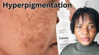 ULTIME GUIDE TRAITEMENT et Routine de Soins HYPERPIGMENTATION pour un TEINT CLAIRE sans TÂCHES [upl. by Eittod]