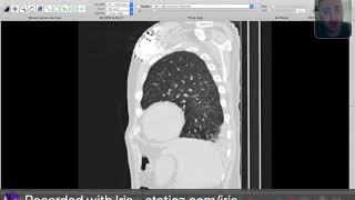 Radiological cases  Chest  CT signs of fissural entrapped pleural effusion [upl. by Llenehs]