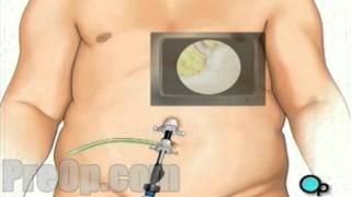 Gastric Adjustable Band Laparoscopic Surgery PreOp® Patient Education Medical Video [upl. by Aleras]