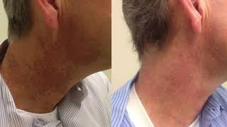 Intense Pulsed Light Therapy IPL For Poikiloderma [upl. by Walczak244]