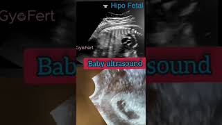 Ultrasound scan in mothers womb ultrasound hipo fital baby boy baby trendingshorts [upl. by Ainslie]