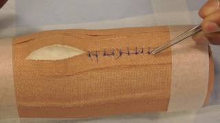 Suture Removal  simple interrupted [upl. by Jamil]