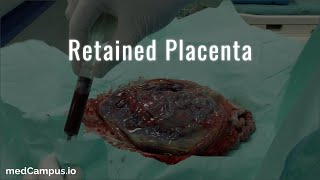 Retained Placenta Management [upl. by Liliane]