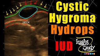 Cystic Hygroma  Hydrops Fetalis  Ultrasound  Anomaly  Case 214 [upl. by Leona]