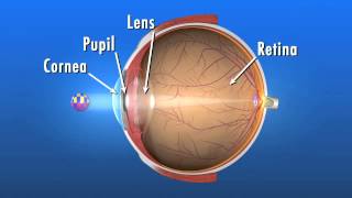 What is a Cataract and how does it affect my vision [upl. by Annaiviv]