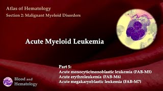 Acute Myeloid Leukemia AML  Part 5 [upl. by Ycats]