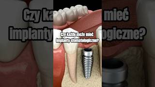 Czy każdy może mieć implanty stomatologiczne implanty implantacja implantystomatologiczne [upl. by Ayouqat477]