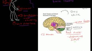 Parkinsons Dementia [upl. by Melvena]