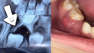 Baby tooth Abscess and extraction [upl. by Cantu]