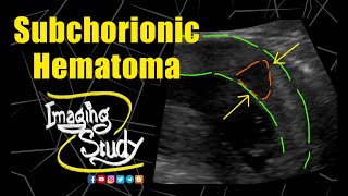 Subchorionic Hematoma  Ultrasound  Case 185 [upl. by Nuhsal]