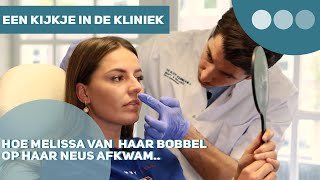 Liquid neuscorrectie met fillers  The Body Clinic [upl. by Anhoj507]