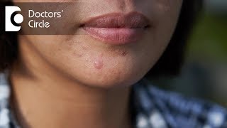 Can creatine monohydrate supplement lead to Acne  Dr Rasya Dixit [upl. by Mcleod310]