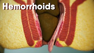 Hemorrhoidsdifferent types of hemorrhoids internal and external Hemorrhoids Hemorrhoids treatment [upl. by Nyllek]