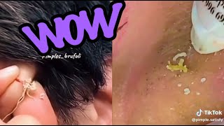 Top Satisfying Pimple Pops of 2024 Blackheads Cysts and More [upl. by Ained]