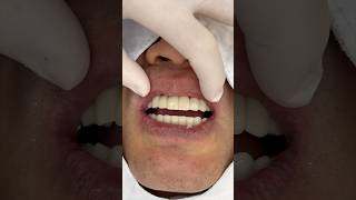 임플란트 세팅과정 dental dentist implantdentist dentalclinic implantdentistry [upl. by Leachim303]