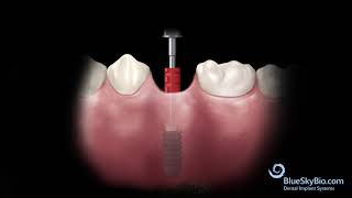 Tissue Level implant and UCLA Abutment [upl. by Yssac866]