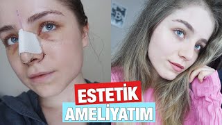 BAŞTAN SONA BURUN ESTETİĞİ AMELİYATIM  Fotoğraflar Vlog ve SoruCevap [upl. by Hahsia]