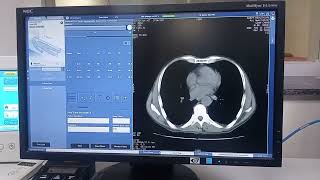 CT AORTOGRAM [upl. by Melisent]