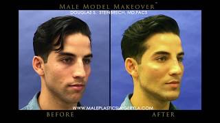 LA Male Model Makeover with Facial Filler by Dr Steinbrech 7 [upl. by Ilajna469]