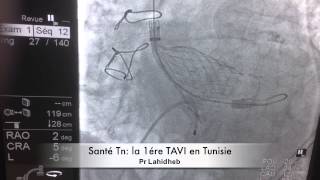 La 1ère TAVI en Tunisie [upl. by Aibos]