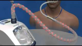 High flow therapy with the AIRVO [upl. by Devol]