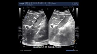 The Gallbladder Mucocele distention [upl. by Refinaj797]