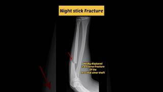 Nightstick fracture  Isolated ulna fracture ulna fracture xray [upl. by Hoxsie]