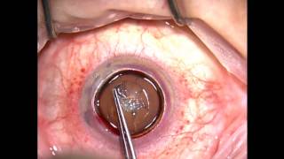 Corneal transplant amp cataract surgery with lens implant Surgeon David Palay MD [upl. by Evvy]