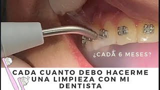 ¿Una 🧼 LIMPIEZA DENTAL 𝗕𝗟𝗔𝗡𝗤𝗨𝗘𝗔 los dientes Como 𝗤𝗨𝗜𝗧𝗔𝗥 el 𝗦𝗔𝗥𝗥𝗢💩 DE LOS DIENTES y BLANQUEARLOS [upl. by Ij]