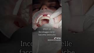 Reel e Trattamenti applicazione delle faccette estetiche parte 3 [upl. by Dnanidref]