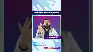 Meckels Diverticulum  Quick Bites [upl. by Hurff]