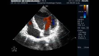 Insuficiencia valvular Aortica  Mitral y Tricuspidea leve Nov 2010 [upl. by Yrtnej]