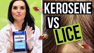 Kerosene For Head Lice Removal  Watch BEFORE YOU TRY [upl. by Zilber202]