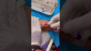 IV Insertion  viral video  Like Share Subscribe amp Follow 👍 [upl. by Asi]