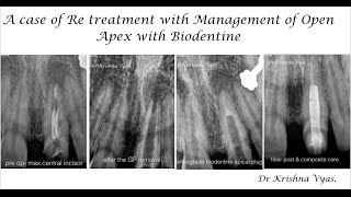 Open Apex Biodentine Retreatement [upl. by Verla581]