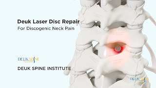 Cervical Deuk Laser Disc Repair DLDR for Discogenic Neck Pain  3D Animation [upl. by Gabbey]