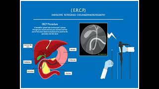 Palliative Care for End Stage Liver Disease [upl. by Quirita626]