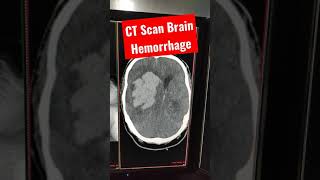 Stroke  Intracranial Hemorrhage CT Scan Brain shorts shortsvideo youtubeshorts [upl. by Deina]