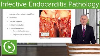 Infective Endocarditis IE Pathology – Infectious Diseases  Lecturio [upl. by Gosser646]