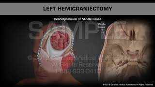 Left Hemicraniectomy  Medical Animation [upl. by Amsirahc697]