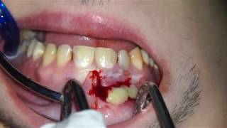 PUS ABSCESS INCISION DRAINAGE Endodontic Root Canal Treatment [upl. by Esalb]