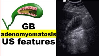 GB Adenomyomatosis US features [upl. by Lucie]