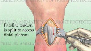 Tibial Fracture repair with Titanium Intramedullary Rod [upl. by Mosra]