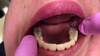 All on 8 Dental implant video 1 [upl. by Audres]