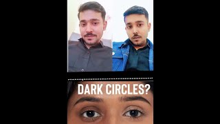 Dark circles 😲 problem dont worry [upl. by Lewap]