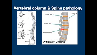 Day 1 Workshop on Disorders Pathology of Spine amp Vertebral column by Dr Hemant Sharma [upl. by Mehala261]