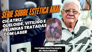 Estética anal Cicatrizqueloide após cirurgias vitiligo e pelinhas anais tratadas laser [upl. by Harlin176]