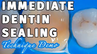 Biomimetic Dentistry Immediate Dentin Sealing with SelfEtch DBA [upl. by Dov]