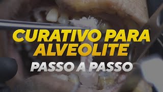 Como fazer um curativo para alveolite [upl. by Tnilk502]