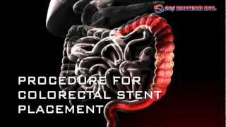 Colorectal Stent [upl. by Richmound816]